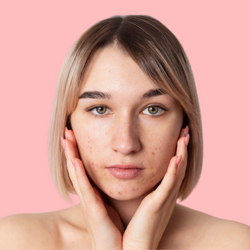 Acne Control